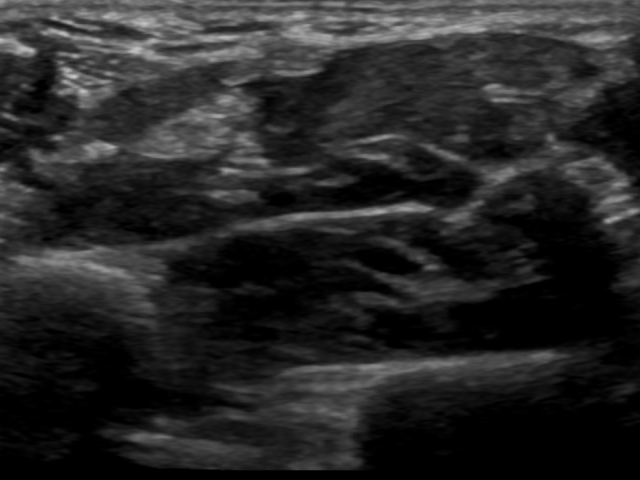 Prediction of 👍Thumb, ☝️Forefinger, ✋Open palm, ✊Fist with B-mode Ultrasound of Forearm preview